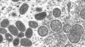 WHO-Monkeypox