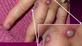 Symptoms of the monkeypox virus are shown on a patient's hand, from a 2003 case in the United States. In most instances, the disease causes fever and painful, pus-filled blisters. New cases in the United Kingdom, Spain and Portugal are spreading possibly through sexual contact, which had not previously been linked to monkeypox transmission.